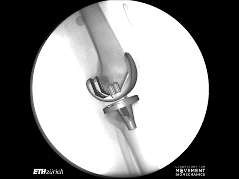 Enlarged view: Total knee arthroplasty subject during walking with a 90° pivot turn